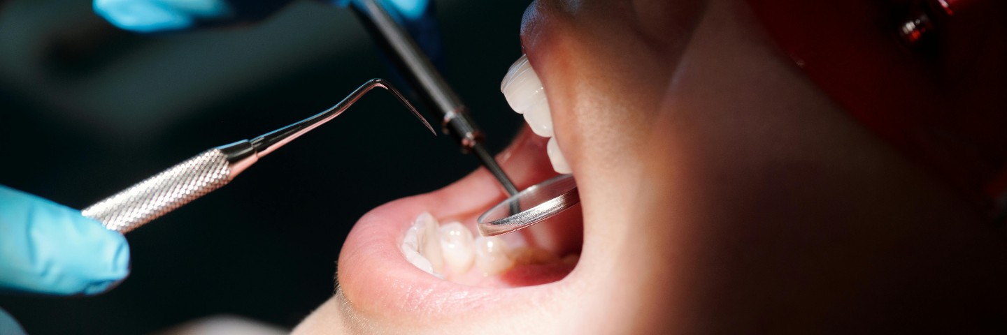 Ultrasonik cihazla diş yüzeyindeki tartar ve plakların hassas bir şekilde temizlenme ani.